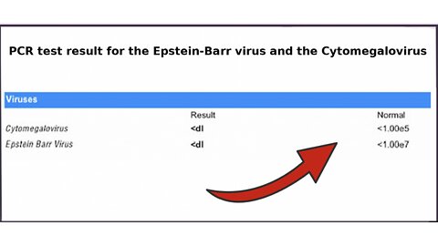 Epstein-Barr Virus PCR Test Result #2 Following Scalar Light Sessions