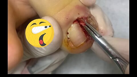 Unha encravada ambos os lados +abscesso | Ingrown toenail on both sides +abscess #nails #podologia