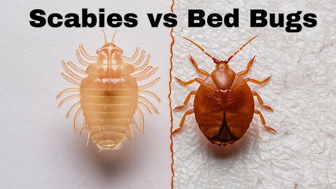 Scabies vs Bed Bugs