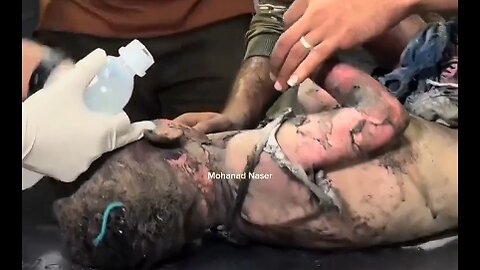 ►🚨▶◾️⚡️⚡️🇮🇱⚔️🇵🇸 Critical Injuries from Israeli fire-belts unleashed on Rafah last night