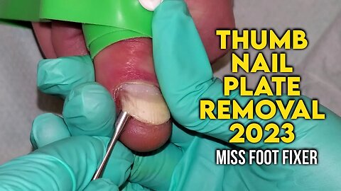 HAND THUMB NAIL PLATE REMOVAL [ NAIL AVULSION ] BY FOOT SPECIALIST MISS FOOT FIXER