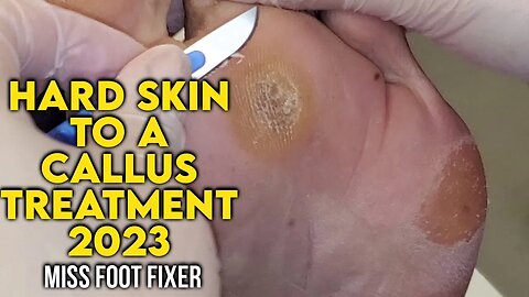 Hard Skin To a Callous - 🦶 Why Does This Happen ?? Full Treatment by Foot Specialist Miss Foot Fixer