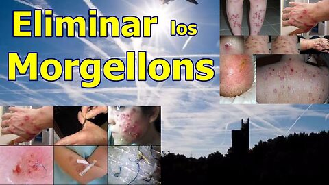 EXTRACCIÓN Y ELIMINACIÓN DE MORGELLONS DE FORMA NATURAL ¿QUÉ LOS CAUSA?