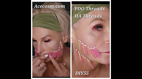 Face lift Acecosm.com DIY55 HA PDO threads