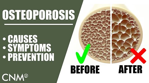OSTEOPOROSIS: The Natural Way To Prevent It