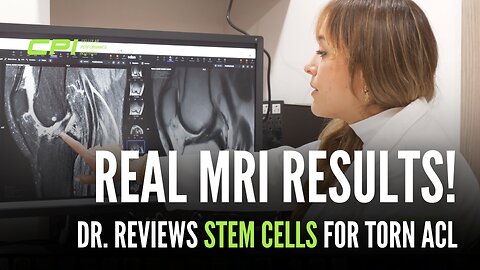 Doctor Reviews Stem Cell Results for Torn ACL - CPI Stem Cells