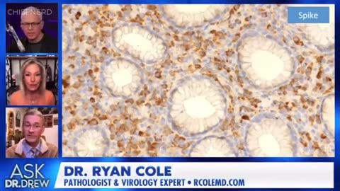 DR. RYAN COLE - CANCER BIOPSY RESULTS - THERE IS SPIKE PROTEIN INSIDE EVERY SINGLE CANCER CELL