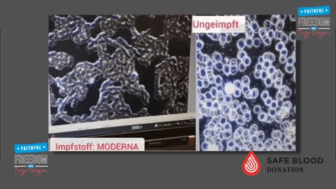 A side-by-side comparison under the microscope of vaccinated blood, vs. unvaccinated blood