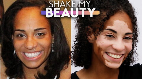 My Skin Condition Made Me Cry - Now I Inspire Others | SHAKE MY BEAUTY