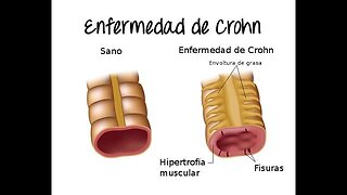 ENFERMEDAD DE CROHN O ILIITIS QUE LA PROVOCA Y SOLUCIONES