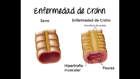 ENFERMEDAD DE CROHN O ILIITIS QUE LA PROVOCA Y SOLUCIONES