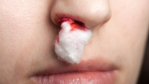 Here's What You Should and Shouldn't Do When You Get a Nosebleed