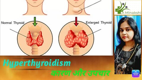Hyperthyroidism की best homeopathic medicine #drminakshisingh