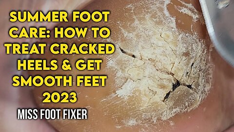 Summer Foot Care: How to Treat Cracked Heels and Get Smooth Feet by foot Specialist Miss foot Fixer