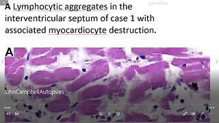 Autopsy-based myocarditis after anti-SARS-CoV-2-vaccination - Dr. John Campbell