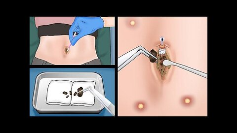 How to Safely Remove a Large Navel Stone with ASMR Animation