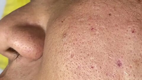 Extraction Big Cystic Acne Blackheads, Whiteheads Removal Pimple Popping