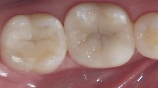Removing Dental Metals