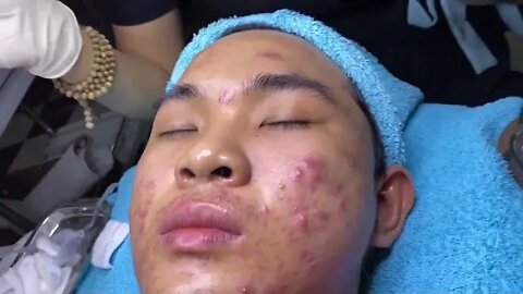 Big Cystic Acne Blackheads Removal / Extraction Blackheads & Milia, Whiteheads Pimple Popping