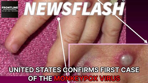 NEWSFLASH: United States Confirms First MONKEYPOX VIRUS Case!