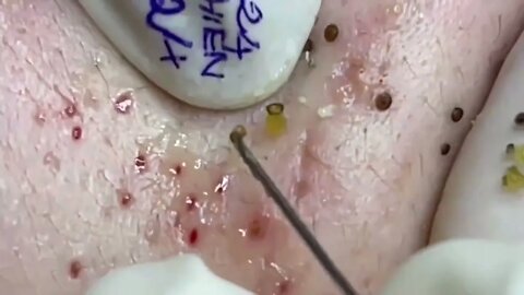 PERFECT!! Removal / extraction of #blackheads and #pimples. Satisfying videos to relax!