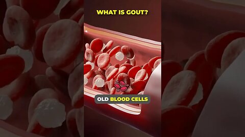 WHAT IS GOUT? #shorts #shortsfeed #gout