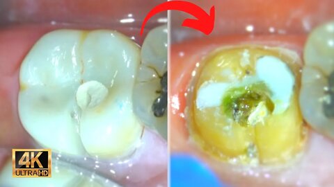 Tooth Decay under a Crown { Cavity Removal Process w/ Microscope }