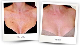 Turn Back Time Spa and Wellness Clinic offers a treatment to remove sun spots, redness, rosacea and more