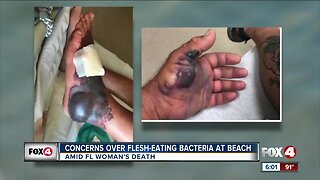CONCERNS OVER FLESH-EATING BACTERIA AT BEACH
