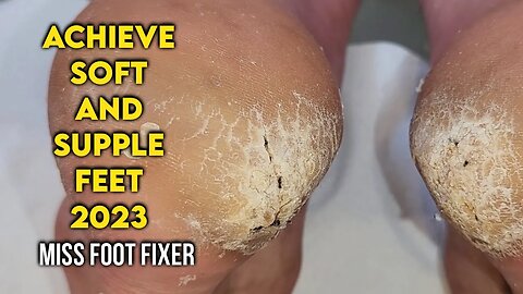 Cracked Heels Treatment: Achieve Soft and Supple Feet by famous Foot Doctor Miss Foot Fixer