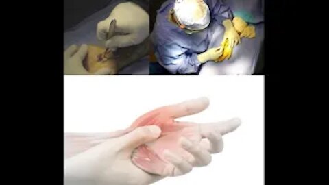 Carpal Tunnel Patient is Left Scar less After Surgery