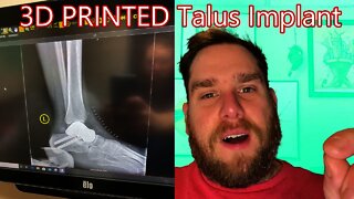 My Journey | 3D Printed Titanium Talus Implant | 20 Months After