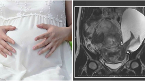 Shocking Image Shows Baby’s Legs Protruding Through The Uterine Wall