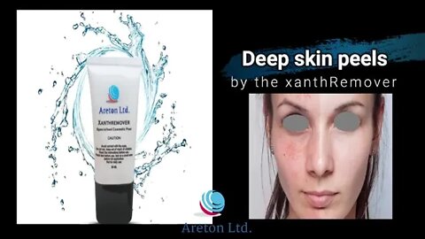 XanthRemover 70% GLycolic acid Gel Peel, for xanthelasma, seborrheic keratosis removal