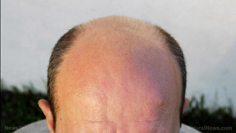 Iron deficiency: Eating foods high in iron and protein helps prevent hair loss in men