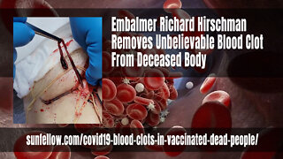 Embalmer Richard Hirschman Removes Unbelievable Blood Clot From Deceased Body