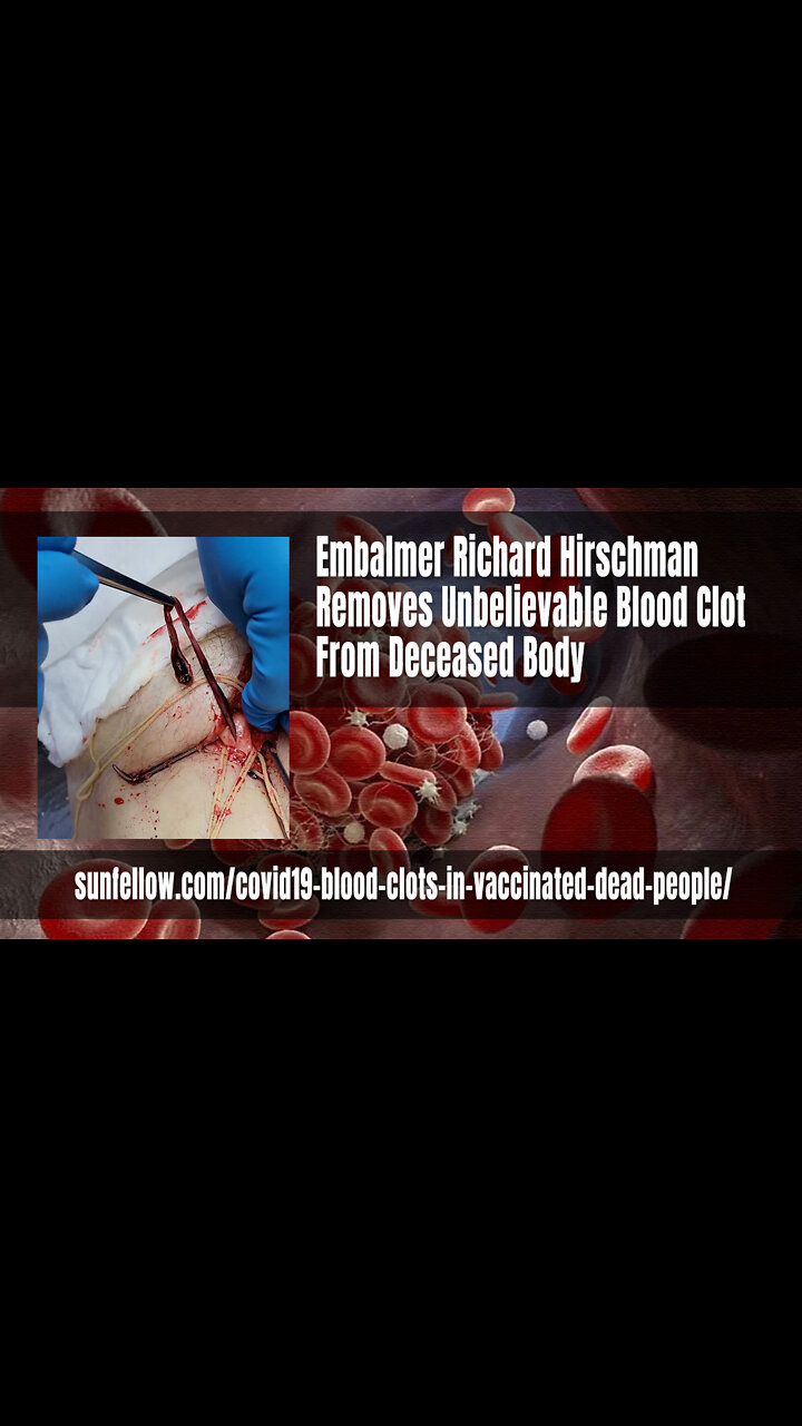 Embalmer Richard Hirschman Removes Unbelievable Blood Clot From