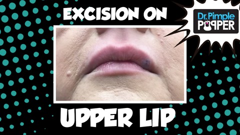 Don't Be Blue: Excision on the Upper Lip