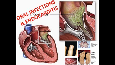 EXCESSIVE SUGAR, FRUCTOSE, CARB CONSUMPTION & Endocarditis risk