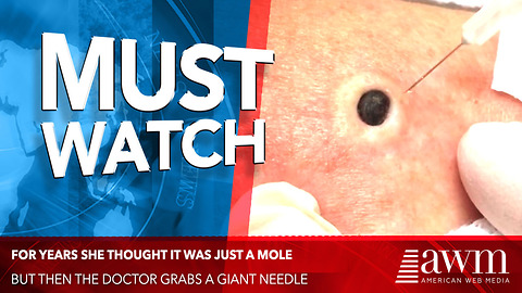 For Years She Thought It Was Just A Mole, But Then The Doctor Grabs A Giant Needle