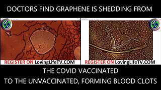 DOCTORS FIND GRAPHENE IS SHEDDING FROM THE COVID VACCINATED TO THE UNVACCINATED, FORMING BLOOD CLOTS