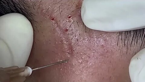 Big Cystic Acne Blackheads Extraction Blackheads & Milia, Whiteheads Removal Pimple Popping