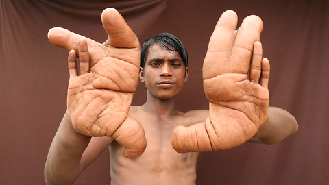 The Boy With The Giant Hands | Born Different