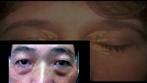 XANTHELASMA AND RECURRENCE