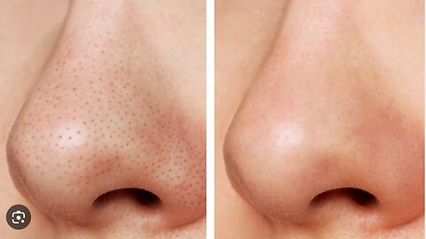 Top 3 Tips to Minimise Nose Pores