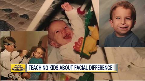 Tampa man helping others understand facial deformity conditions ahead of new movie 'Wonder'