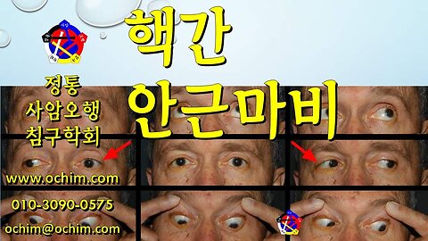 핵간 안근마비 치료 방법 - 사암침법, 사암오행침, 오행침