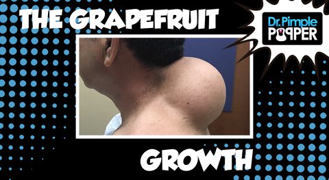 THE Grapefruit-sized Growth!