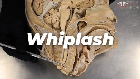 Your Spine on Whiplash: A Closer Look at the Trauma