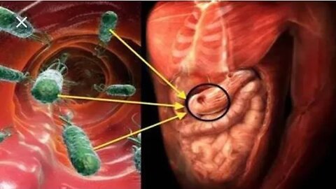 #Bacteria #H.pylori #Tratamento #Cuidados Cirurgia Bariátrica VS Bactéria H.Pylori